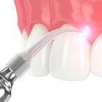 3d render of dental diode laser used to treat gums. The concept of using laser therapy in the treatment of gums. Example of modern dentistry