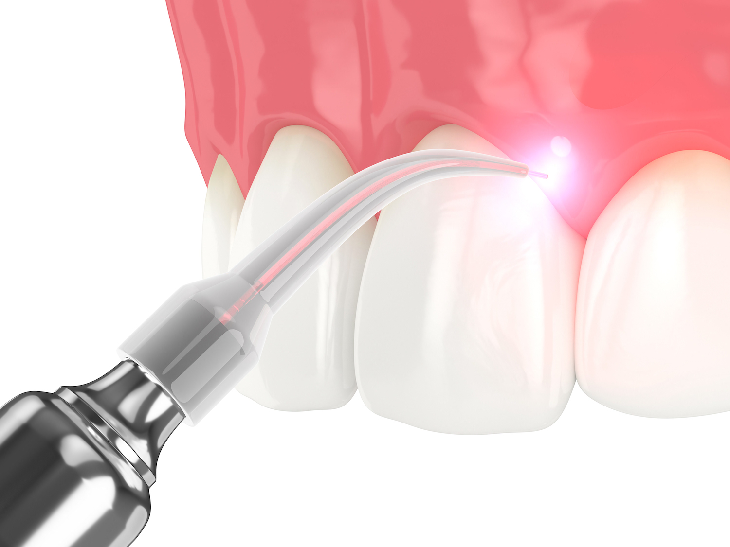 3d render of dental diode laser used to treat gums. The concept of using laser therapy in the treatment of gums. Example of modern dentistry