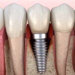 periimplantitis of dental implant, dental implant failing or dental implant failure