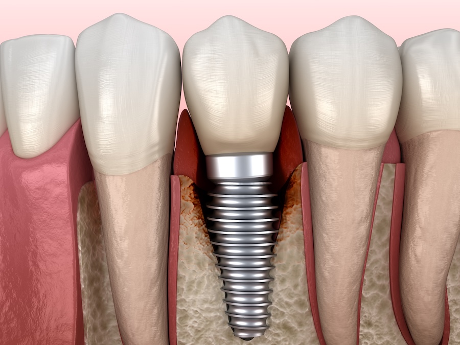 periimplantitis of dental implant, dental implant failing or dental implant failure