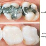 replacing old fillings that are amalgam with composite tooth colored fillings