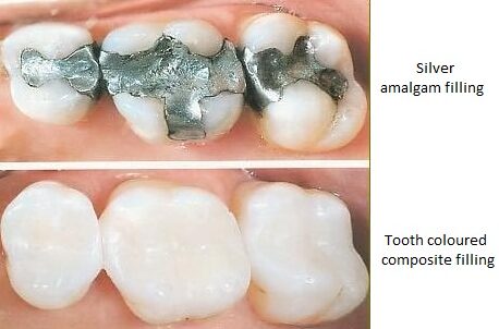 replacing old fillings that are amalgam with composite tooth colored fillings