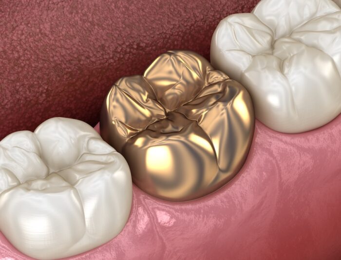 gold dental crown, gold crown