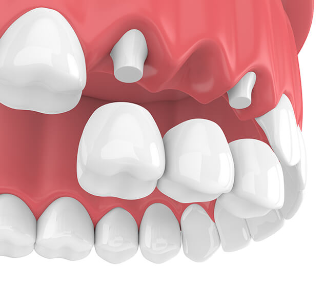 illustration of a dental bridge