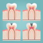 cavity progression, stage 1 cavity