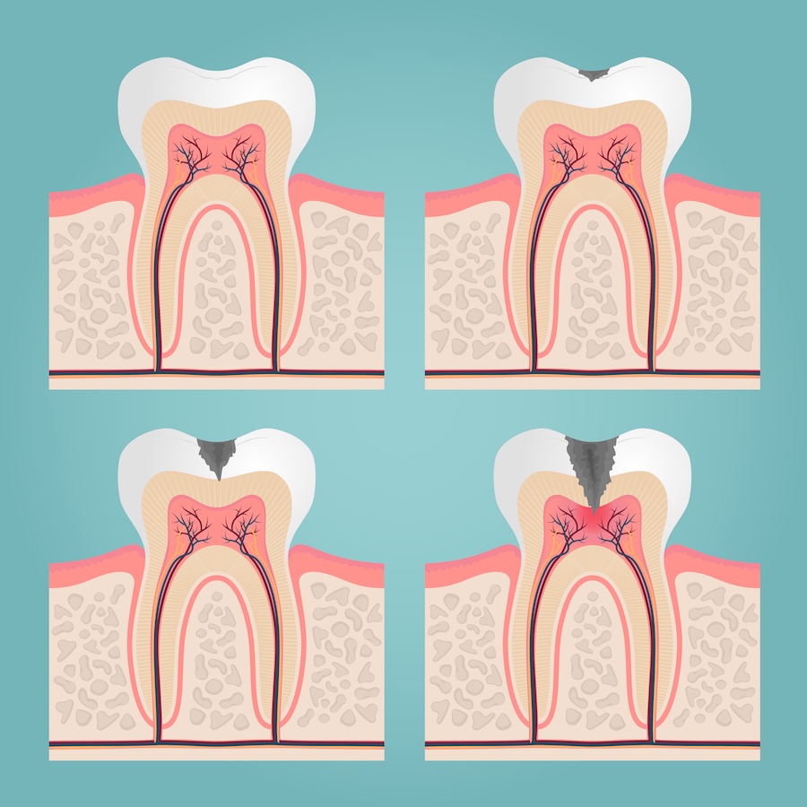 cavity progression, stage 1 cavity