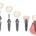 loose dental implant, parts of a dental implant