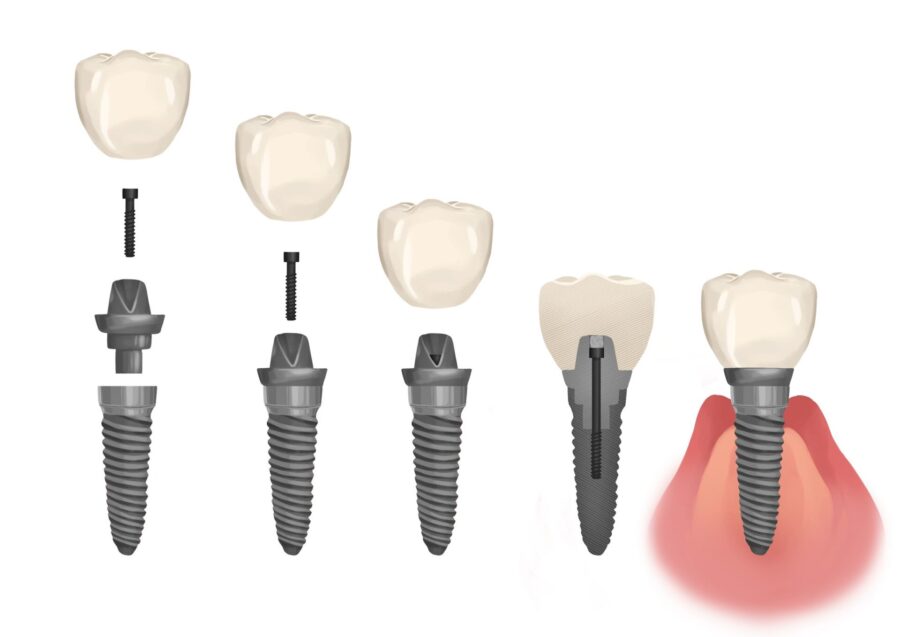 loose dental implant, parts of a dental implant